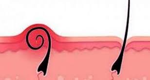 Kil Donmesi Belirtileri Nedenleri Ve Tedavi Yontemleri