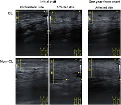 Image result for Lipodermatosclerosis