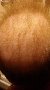 These brushes have been proven to naturally condition hair, improve hair texture, decrease the need for styling products, stimulate the production of healthy oils, and reduce the need for constant washing. Boar Hair Brush 8 Months In Hair Regrowth Balding