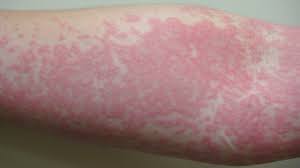 Find the perfect rash face stock photos and editorial news pictures from getty images. Best Sunscreen For Heat Rash In 2021 Simplysunsafe