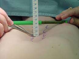 Maybe you would like to learn more about one of these? Pectus Excavatum My Tips For Organizing Surgery And Finding An Insurance Cover Hubpages