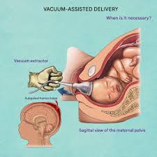 Image result for Vacuum Caput