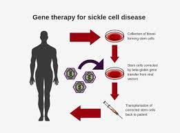 Sickle cell disease is particularly common in people with an african or caribbean family background. Nih Researchers Create New Viral Vector For Improved Gene Therapy In Sickle Cell Disease National Institutes Of Health Nih
