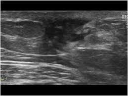 No one knows exactly what causes male breast cancer. Breast And Axilla 5 8 Male Breast Case 5 8 3 Various Lesions Of The Male Breast Ultrasound Cases