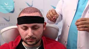 Placing A Hat After Hair Transplantation Youtube