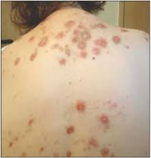 Image result for Neurotic Excoriation