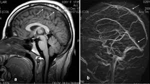Although, the frequency of cerebral venous sinus thrombosis (cvst) has dropped remarkably in recent years but unfortunately, it is still seen commonly in a developing country like pakistan. Cerebral Venous Sinus Thrombosis Review Of The Demographics Pathophysiology Current Diagnosis And Treatment In Neurosurgical Focus Volume 27 Issue 5 2009