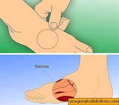 Mogu se javiti i na strani tabana i na samim prstima. Kako Lijeciti Prijelom Stresa Na Stopalu 12 Koraka Sa Slikama Prijelomi Stopala