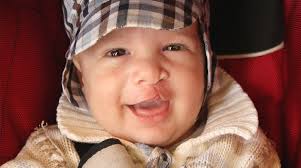 Image result for Cleft Lip