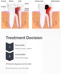 Image result for Pulpitis