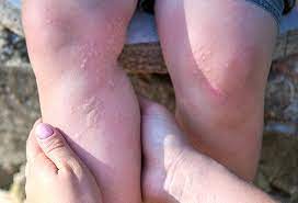 When these needles come in to contact with skin, the person's body releases histamine that may cause hives within a few minutes after being exposed. What Does Stinging Nettle Do To The Body