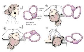 Image result for Canalith Repositioning Procedure