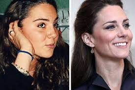 Kate Middleton Plastic Surgery Before And After Photos Pics 2013 2014 Celebrity Plastic Surgery Plastic Surgery Kate Middleton