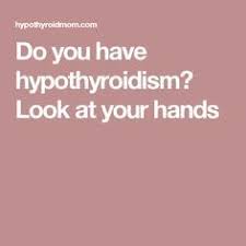 Do You Have Hypothyroidism Look At Your Hands Hypothyroid Mom Hypothyroidism Diet Thyroid Symptoms Hypothyroidism