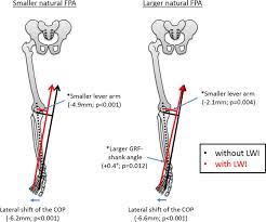 Image result for Foot Progression Angle
