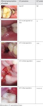 Dry socket is a painful dental condition that is also refereed as alveolar osteitis. Scoring System Employed For Granulation Tissue Formation In The Dry Socket Download Scientific Diagram