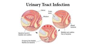 Best Urinary Tract Infections Treatment Diagnosis India Rg Hospital
