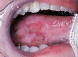 Oral cancer may appear differently based on its stage, location in the mouth, and other factors. Oral Cancer Images The Oral Cancer Foundation