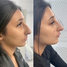 What is a Liquid Rhinoplasty? 👃 It is where dermal filler is strategically  placed to help banish any dips in the nose and lift the tip to create a  more balanced in