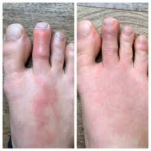 Case Study Suggests Possible Link Between Drop Foot And Covid 19 Podiatry Today
