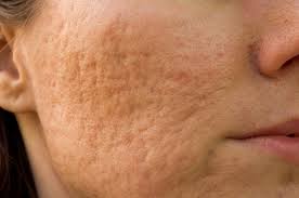 Pockmarks: Definition, Causes, And Treatment