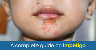 Image result for Impetigo
