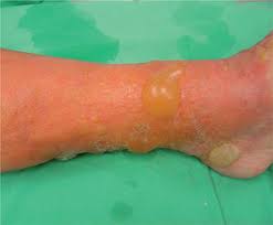 Image result for dermatitis contacta toxica