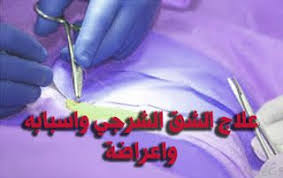 طبيبكم علاج الشرخ الشرجي blog posts blog post