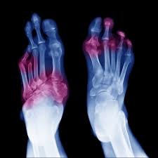 Though it usually affects your extremities, like your toes and fingers, it can also affect your internal organs. Gangrena Medlineplus En Espanol