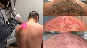 Laser Tattoo Removal The Ugly Truth Youtube