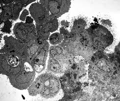 But was present on microscopy of the lungs at necropsyin six cases. Malignant Mesothelioma Springerlink