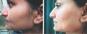 Laser hair removal is a process where light (aka the laser beams) is directed onto your skin in little pulses, targeting and heating up the hair follicle to destroy a portion of. Facial Laser Hair Removal Ultimate Guide London Premier Laser