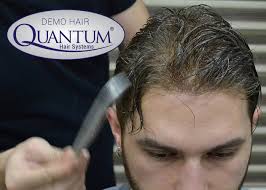 Demo Hair Quantum Sistem Nedir Protez Sac Blog Demo Hair
