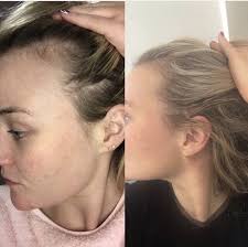 The loss is diffuse and involves the entire scalp rather than discrete areas. Pin On Viviscal Before After
