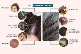 Image result for lice vs dandruff