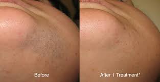 Laser hair removal is the process of hair removal by means of exposure to pulses of laser light that destroy the hair follicle. Laser Hair Removal Orlando Fl