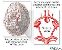 We'll also explain how to prevent and treat aneurysms. Aneurysm In The Brain Healthing Ca