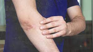 Pde4 controls the inflammatory action within a cell, which can affect the level of inflammation associated. Psoriasis And Urea What To Know