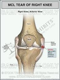 Mcl Tear Of The Right Knee Mcl Injury Ligament Tear Knee Joint Anatomy