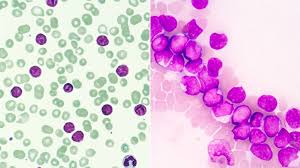 there are many types of leukemia everyday health