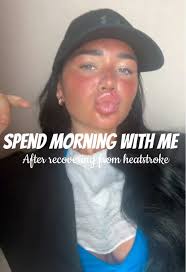 Sunburn to Tan in Thailand