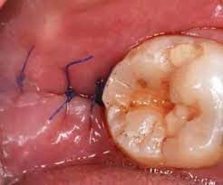 Extracting An Impacted Tooth In Shenzhen Impacted Tooth Wisdom Teeth Impacted Wisdom Teeth