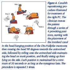 Image result for Canalith Repositioning Procedure