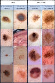 At gsk, we appreciate your commitment to providing quality care to patients in a safe environment. Deep Neural Networks Are Superior To Dermatologists In Melanoma Image Classification European Journal Of Cancer