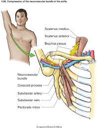 Thoracic Outlet Syndrome Tos Physiopedia