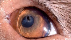 Image result for Eye Foreign Body