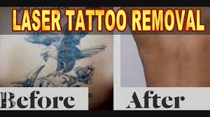 Be clear whether you would rather do a cover up or. Laser Tattoo Removal Chandigarh India Youtube