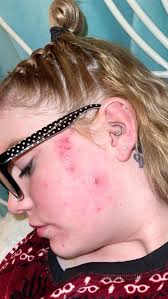 What is the worst symptom you have to manage?