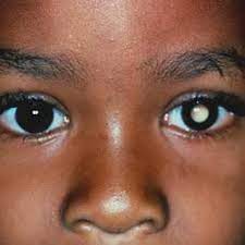 Feasibility of thermal infrared imaging screening for breast cancer in rural communities of southern mexico: Uzivatel Fondation Bomoko Na Twitteru Mot Du Jour Le Retinoblastome Rb Definition Il Constitue La Tumeur Intraoculaire De L Enfant La Plus Commune Il S Agit D Une Neoplasie Mettant En Jeu Le Pronostic