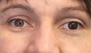 Image result for nevus sclerae